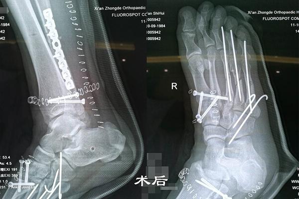 崴脚导致足踝骨折 为何要进行三次手术