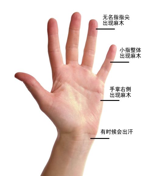 “鼠标手”长期不治，可能导致手部肌肉萎缩